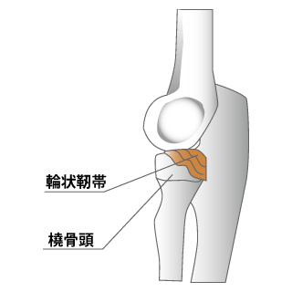 肘内障のイメージ図